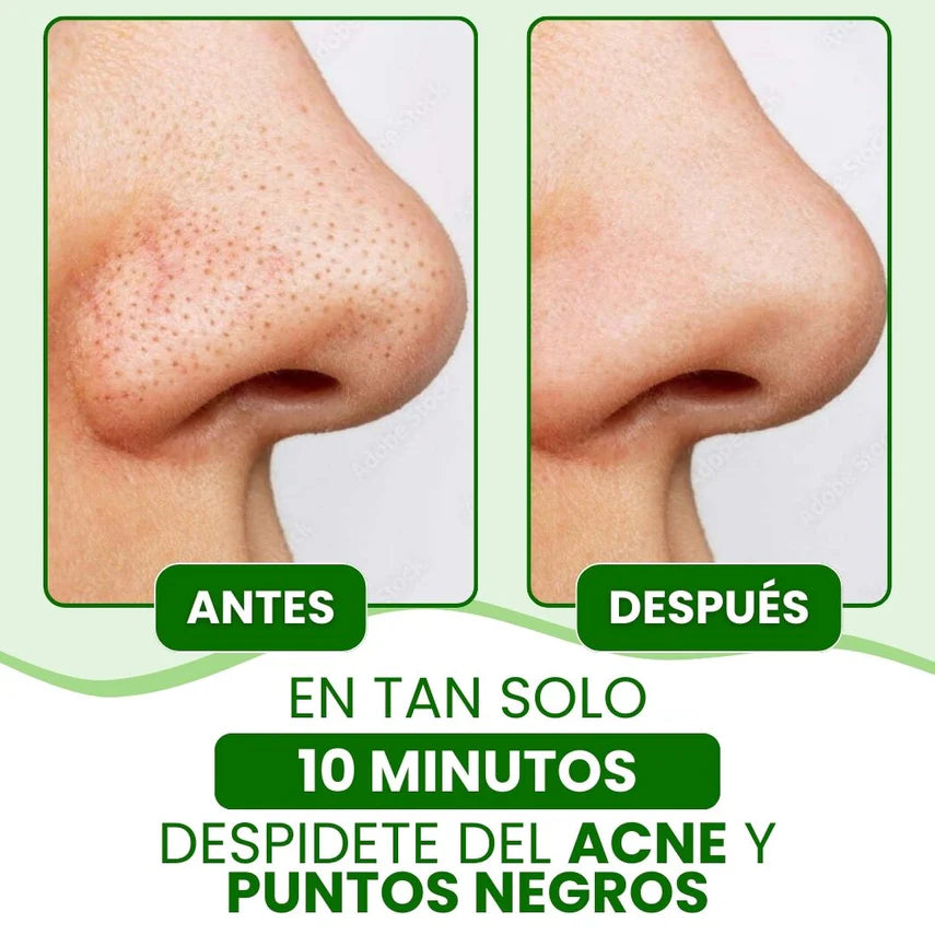 Lanbena® — Mascarilla Avanzada para Puntos Negros